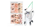 Fotona laser 4 D Erbium