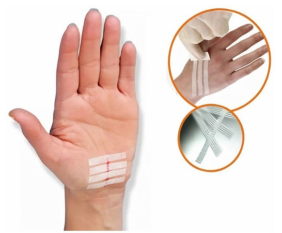 KELOGEL STRIP SUTURA CUTÂNEA ADESIVA COM 60 TIRAS 12MMx100MM - MEDFORMA